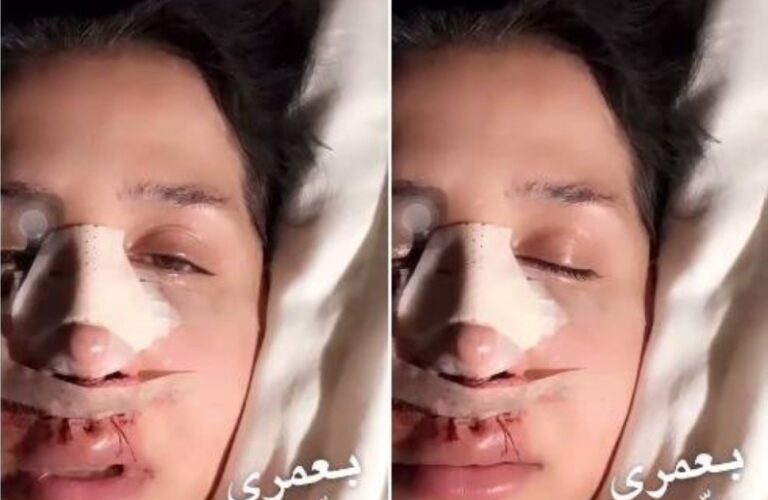 شاهد كيف تشوهت هند القحطاني بعد عملية تجميل فاشلة كلفتها الملايين